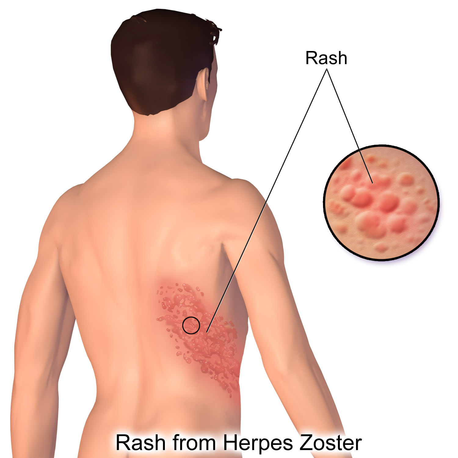 Post Herpetic Neuralgia